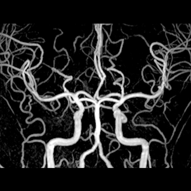 脳血管の検査（MRA）
