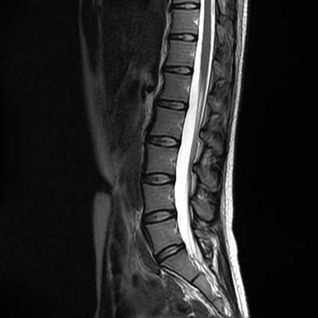 脊椎・脊髄の検査