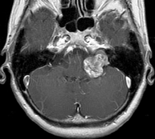 聴神経腫瘍イメージ