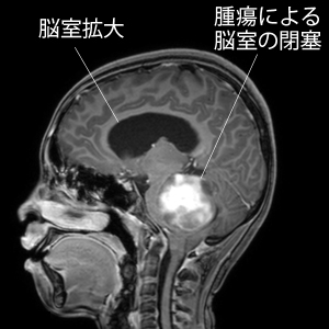 続発性水頭症 | 福岡の脳神経外科 - はしぐち脳神経クリニック