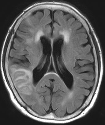 アテローム血栓性脳梗塞 | 福岡の脳神経外科 - はしぐち脳神経クリニック