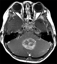 MRI enhanced T1WI axial