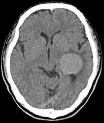 脳室内腫瘍 | 福岡の脳神経外科 - はしぐち脳神経クリニック